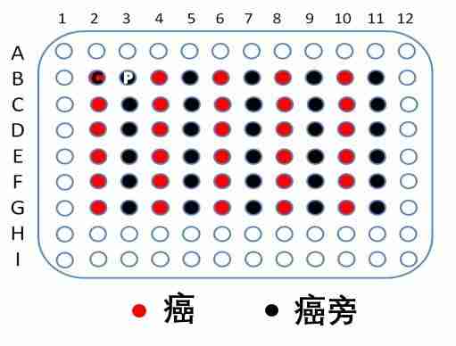 胃癌组织cDNA芯片cDNA-HStmH030CS01