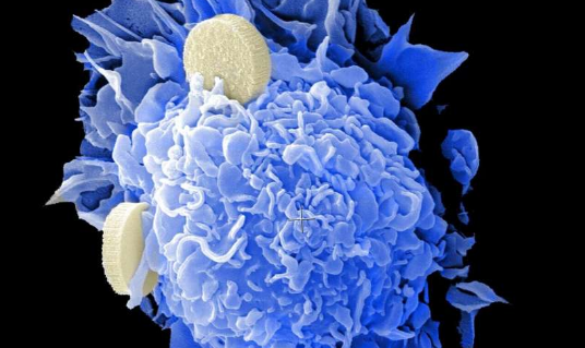 Cancer Med：中国科学家新成果！特殊的外泌体分子或能改善抗癌药物向肿瘤的运输效率！