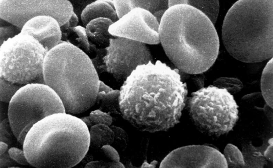科学家识别出能帮助杀灭膀胱癌细胞的特殊免疫细胞