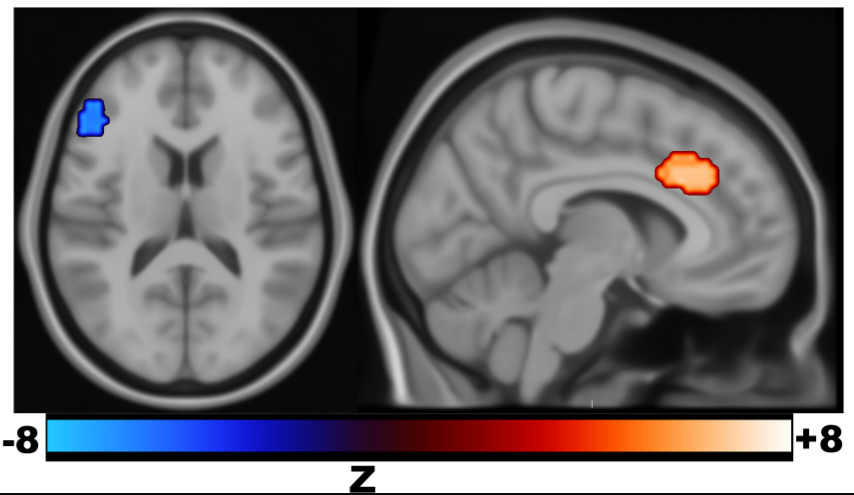 PNAS：逆转神经信号！科学家揭秘经颅磁刺激治疗重度抑郁的机制- 医疗 